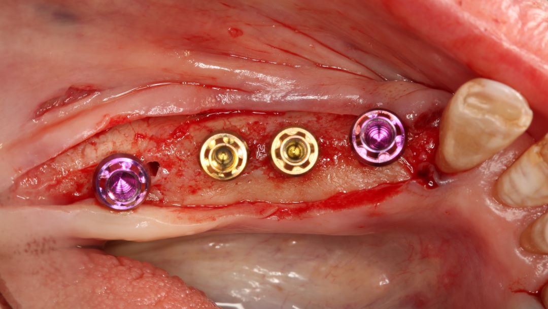 Máster Implantología Dental - CEPUME