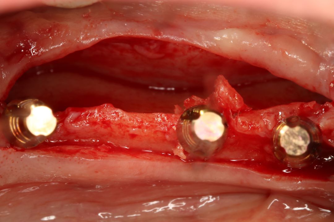 Máster Implantes Dentales y Rehabilitación
