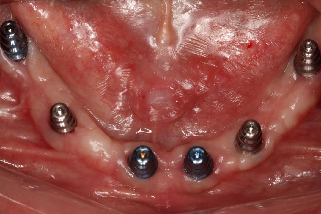 Máster Implantes Dentales y Rehabilitación